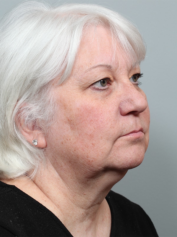 Before Image: Upper Blepharoplasty with Xanathelasma Excision - right-front-oblique