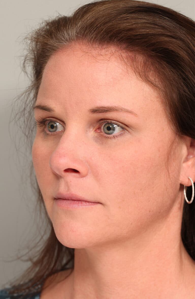 After Image: Endoscopic Browlift - left-front-oblique