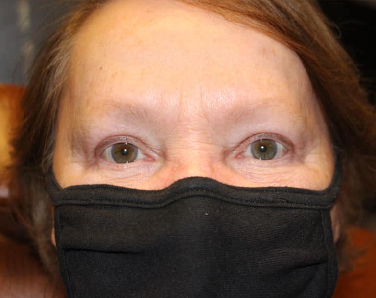 After Image: Upper Blepharoplasty - front