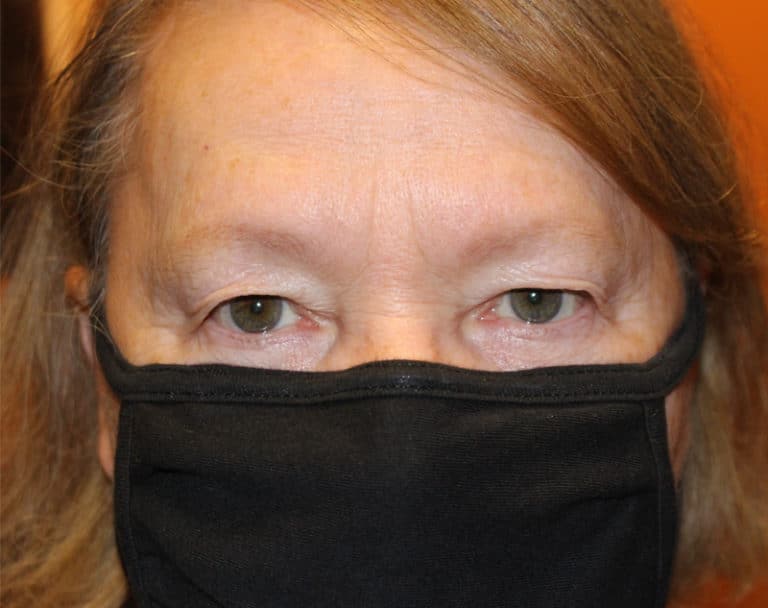 Before Image: Upper Blepharoplasty - front
