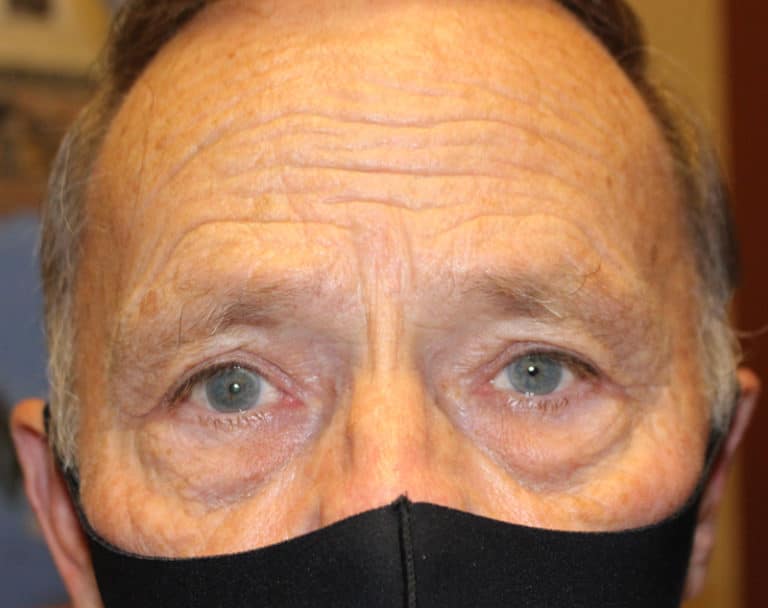 After Image: Upper Blepharoplasty - front