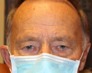 Upper Blepharoplasty