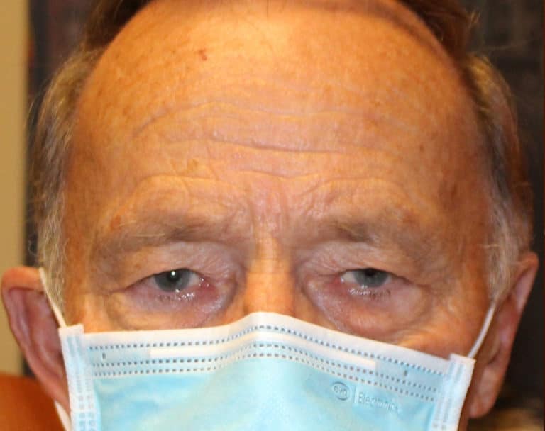 Before Image: Upper Blepharoplasty - front
