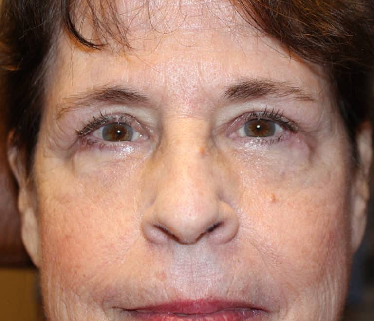 After Image: Upper & Lower Blepharoplasty - front