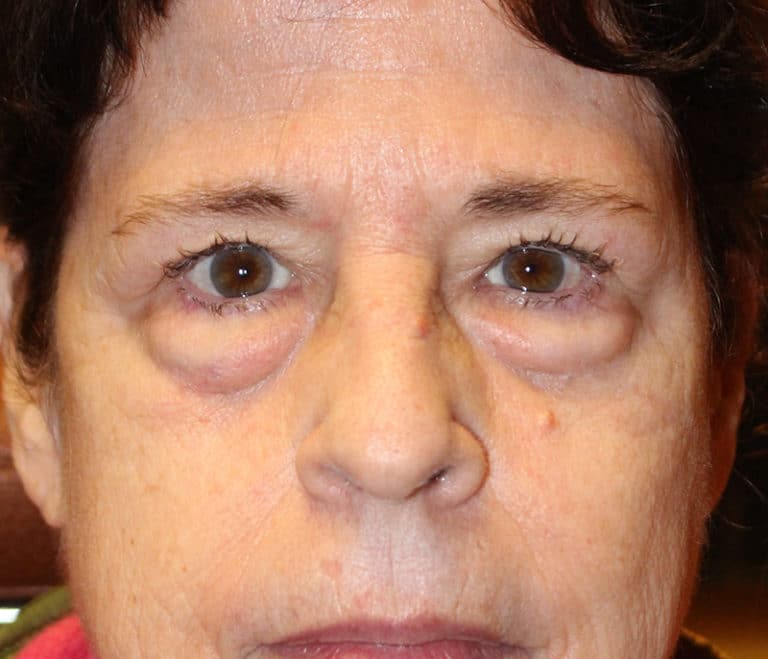 Before Image: Upper & Lower Blepharoplasty - front