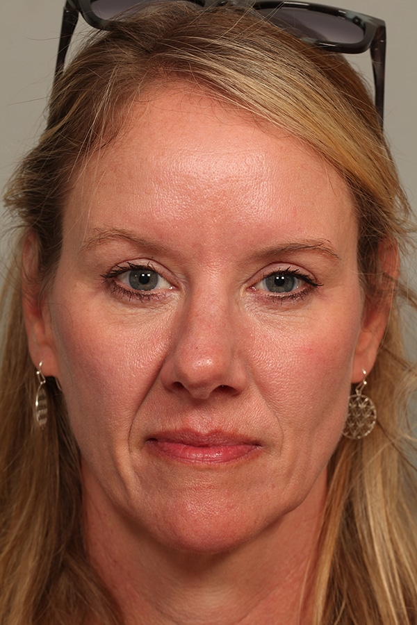 After Image: Upper Blepharoplasty - front