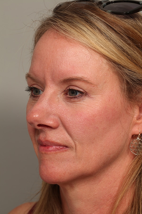 After Image: Upper Blepharoplasty - left-front-oblique