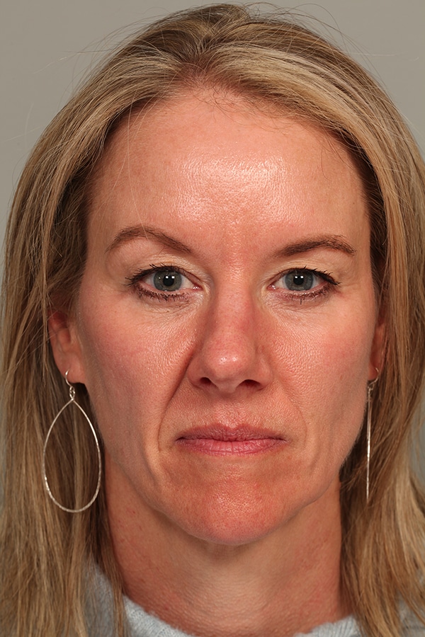 Before Image: Upper Blepharoplasty - front