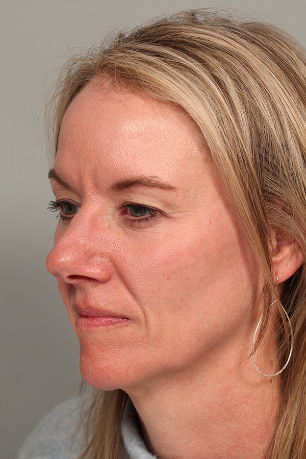Before Image: Upper Blepharoplasty - left-front-oblique