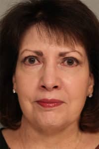 After Image: Facelift, Necklift, Upper and Lower Eyelid Surgery