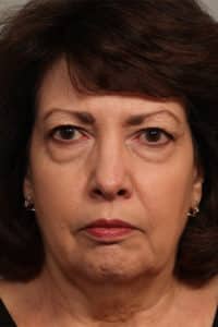 Before Image: Facelift, Necklift, Upper and Lower Eyelid Surgery