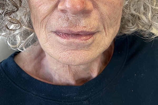 Before Image: Lip Lift - front