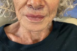 Lip Lift