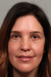 Upper and Lower Blepharoplasty