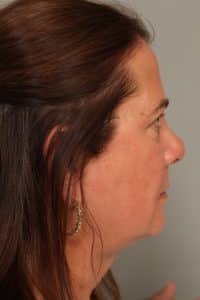 Neck Liposuction