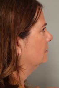 Neck Liposuction