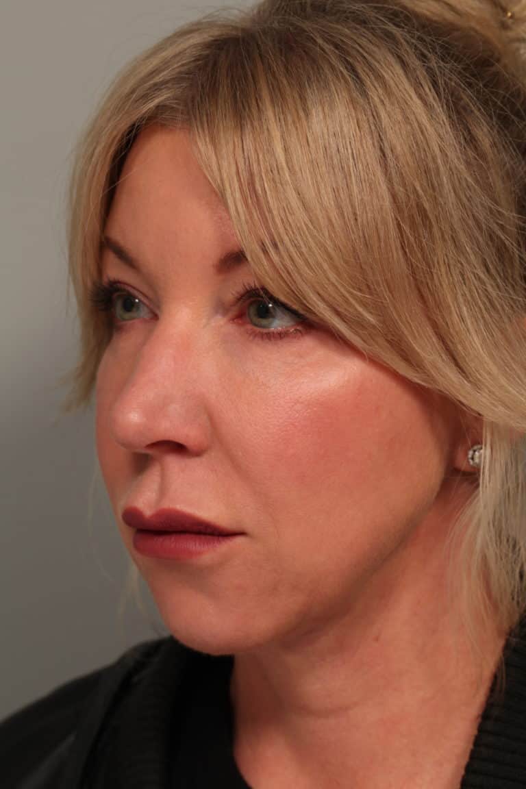 After Image: Facetite with Neck Liposuction, Morpheus8, Restylane to Lower Lids - left-front-oblique