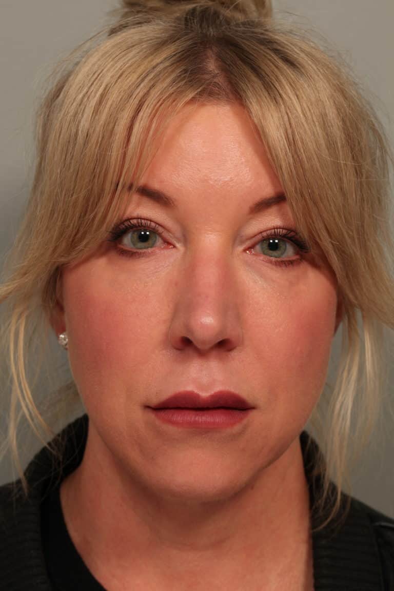 After Image: Facetite with Neck Liposuction, Morpheus8, Restylane to Lower Lids - front