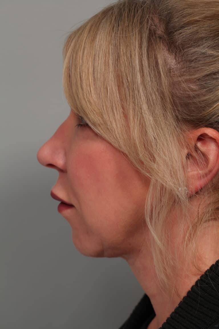 After Image: Facetite with Neck Liposuction, Morpheus8, Restylane to Lower Lids - left-side