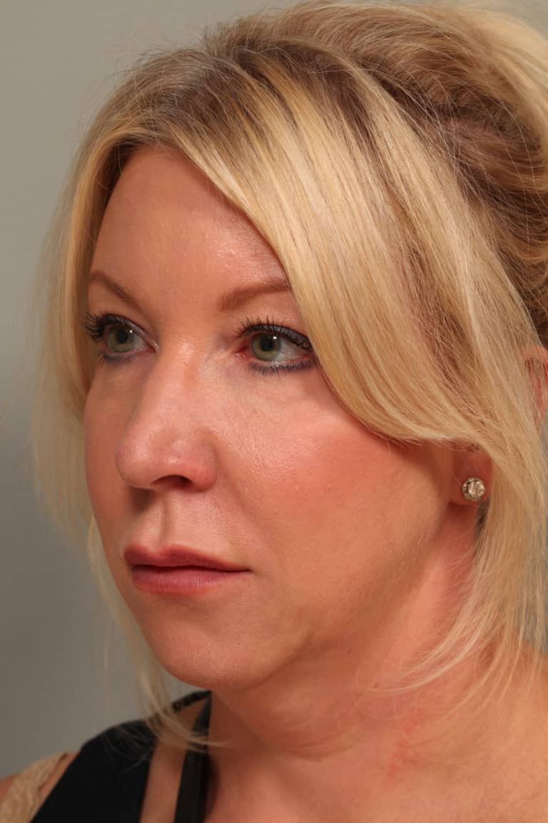 Before Image: Facetite with Neck Liposuction, Morpheus8, Restylane to Lower Lids - left-front-oblique