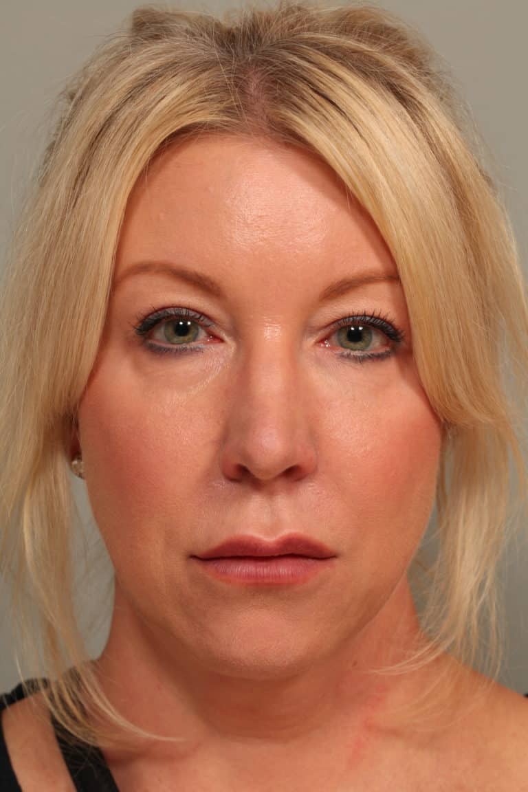 Before Image: Facetite with Neck Liposuction, Morpheus8, Restylane to Lower Lids - front