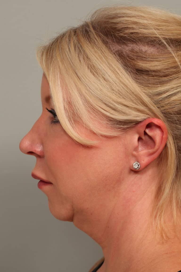 Before Image: Facetite with Neck Liposuction, Morpheus8, Restylane to Lower Lids - left-side