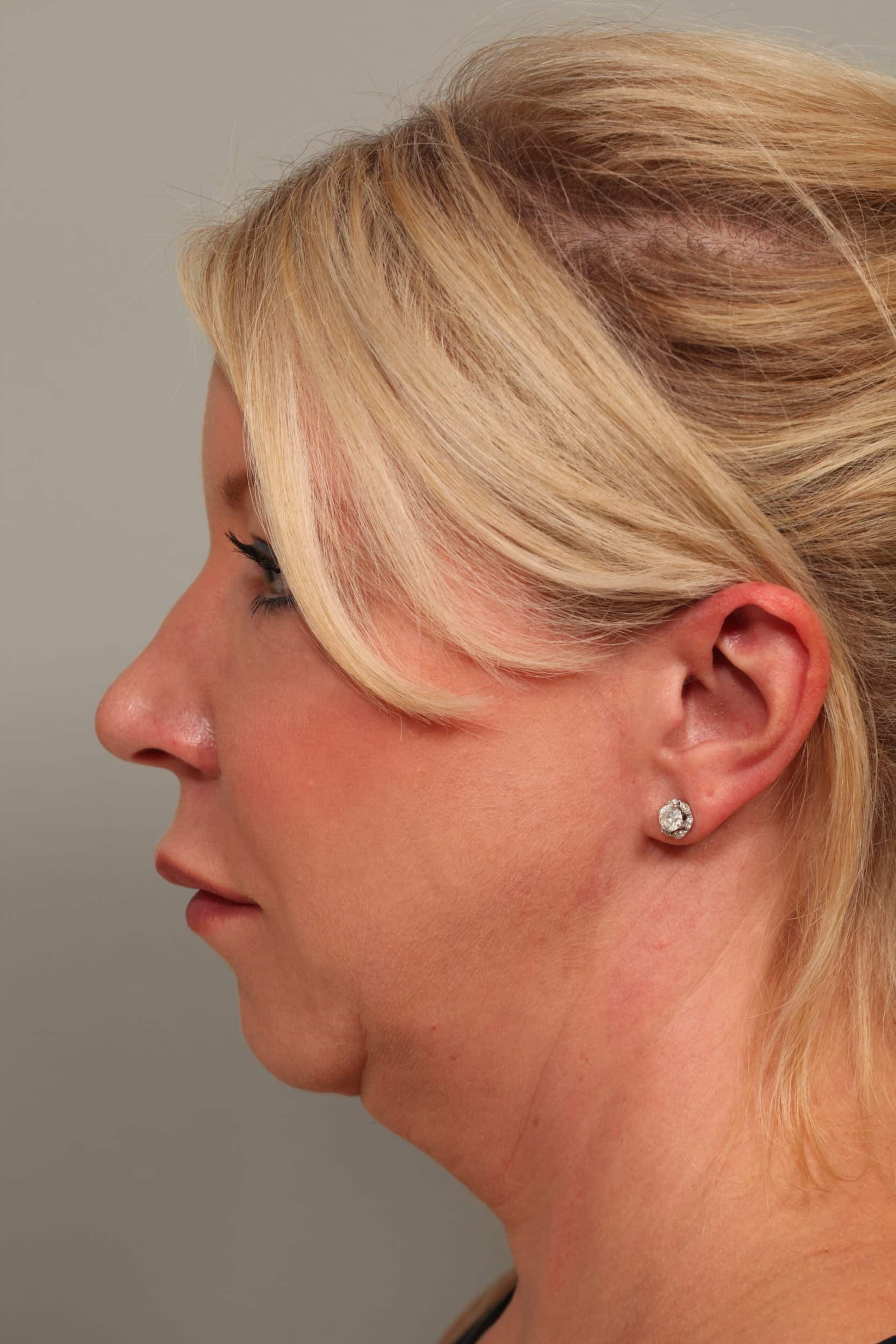 Before Image: Facetite with Neck Liposuction, Morpheus8, Restylane to Lower Lids - left-side