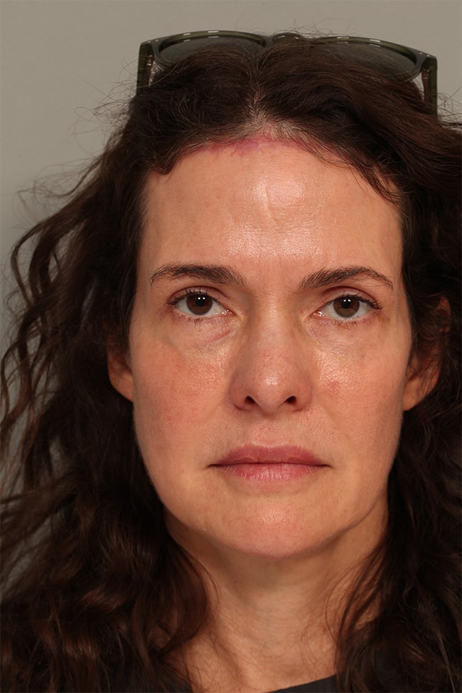 After Image: Pretrichial Browlift - front