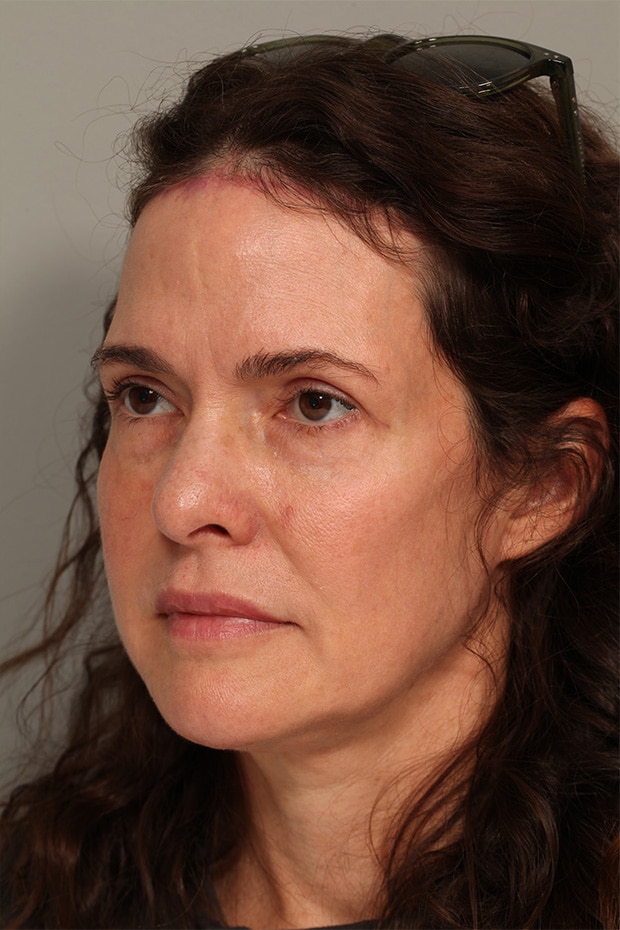 After Image: Pretrichial Browlift - left-front-oblique