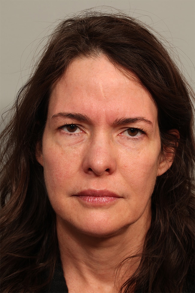 Before Image: Pretrichial Browlift - front