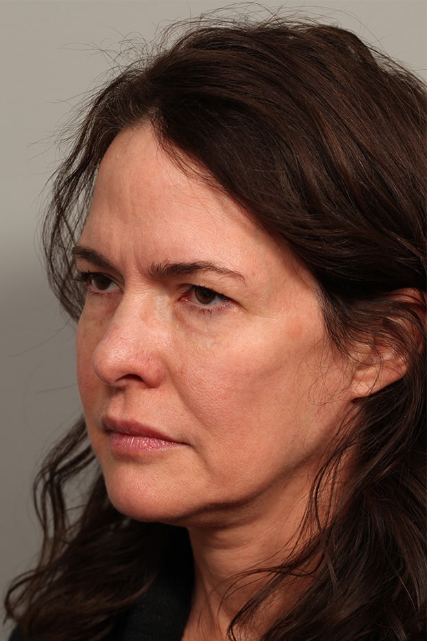 Before Image: Pretrichial Browlift - left-front-oblique