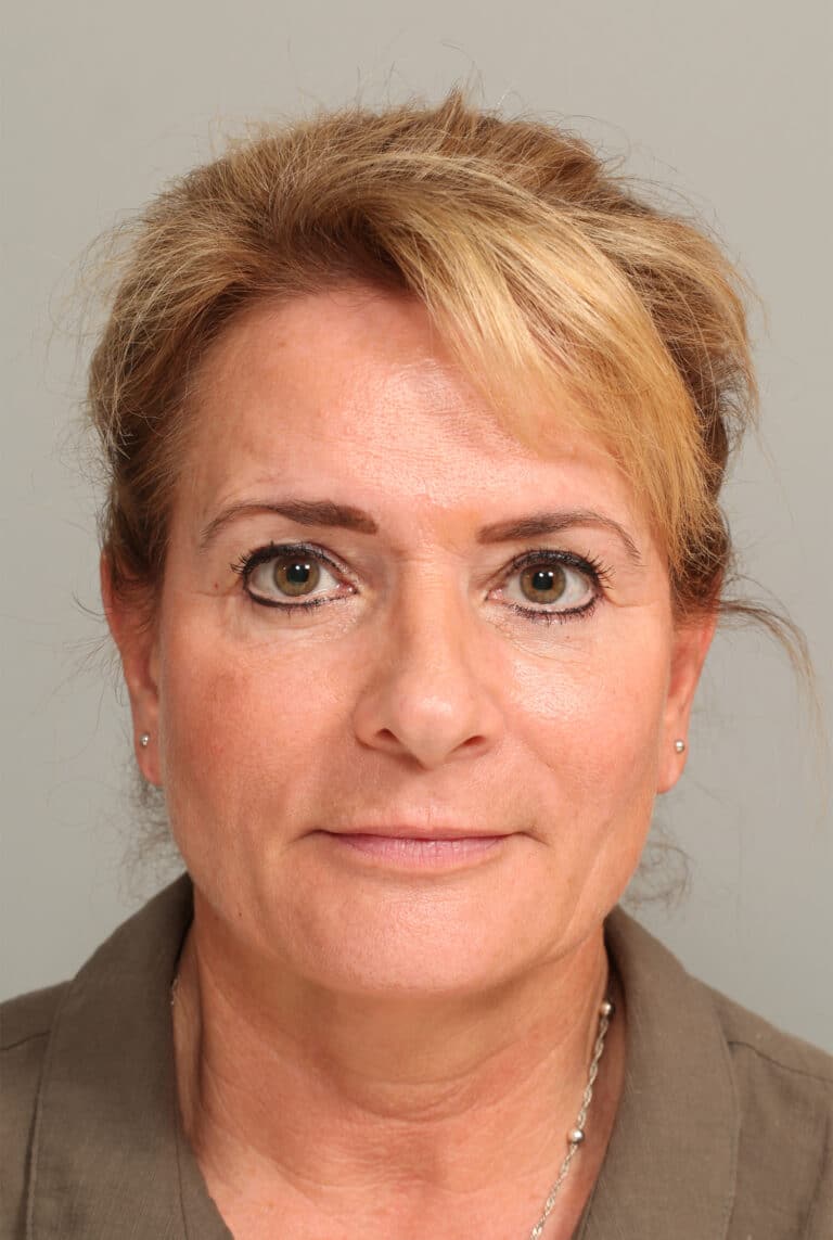 After Image: ENDOSCOPIC BROWLIFT AND LOWER BLEPHAROPLASTY - front