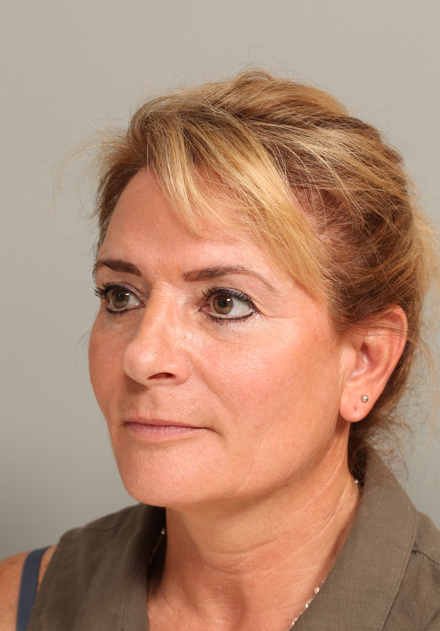 After Image: ENDOSCOPIC BROWLIFT AND LOWER BLEPHAROPLASTY - left-front-oblique