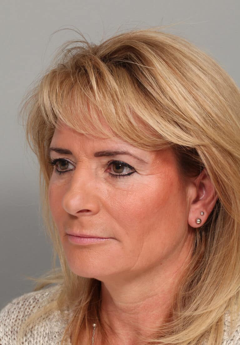 Before Image: ENDOSCOPIC BROWLIFT AND LOWER BLEPHAROPLASTY - left-front-oblique