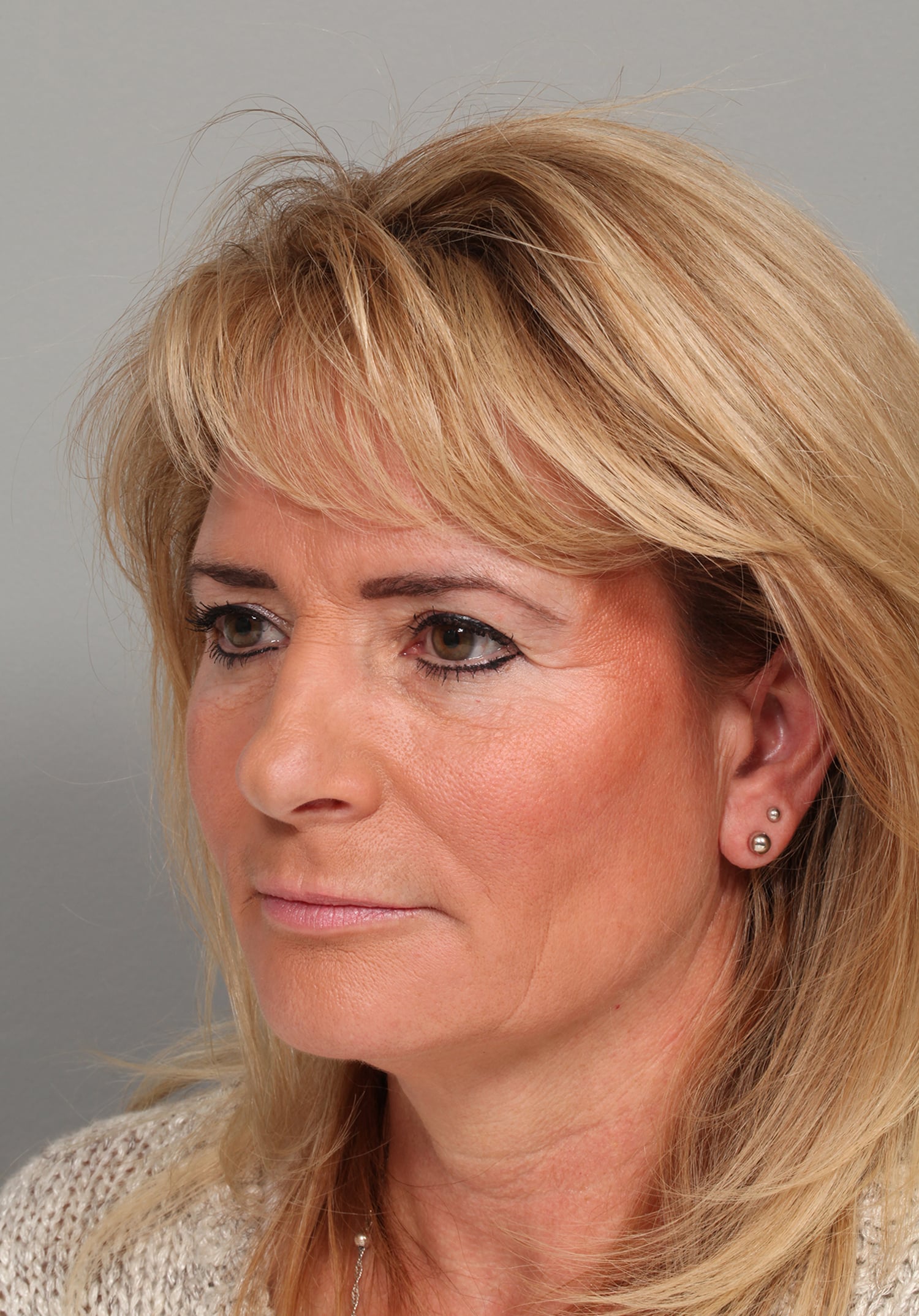 Before Image: ENDOSCOPIC BROWLIFT AND LOWER BLEPHAROPLASTY - left-front-oblique