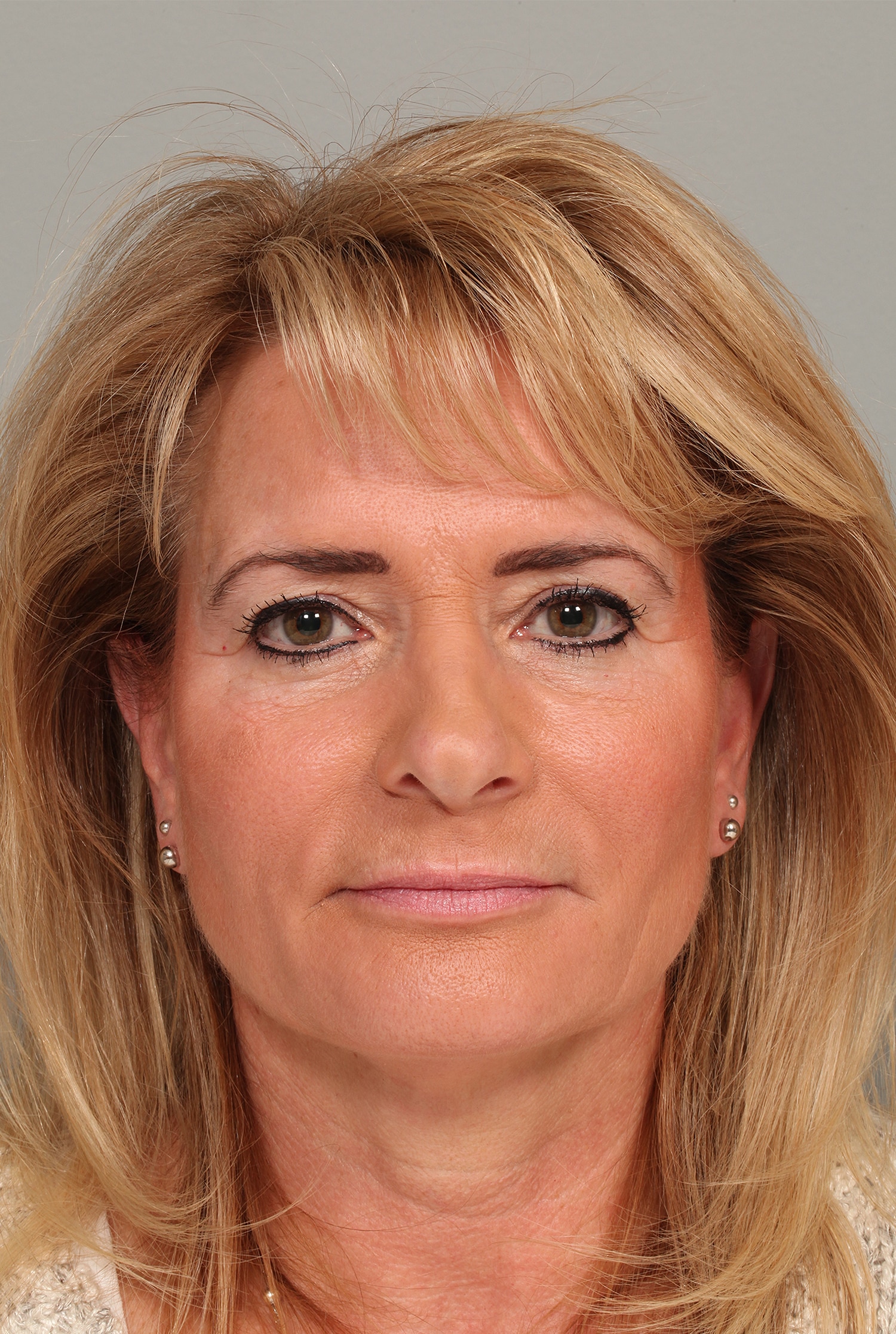Before Image: ENDOSCOPIC BROWLIFT AND LOWER BLEPHAROPLASTY - front