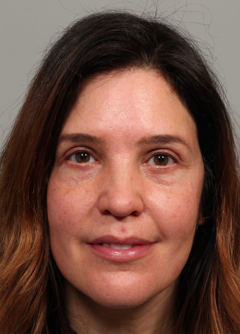 After Image: Upper and Lower Blepharoplasty - front
