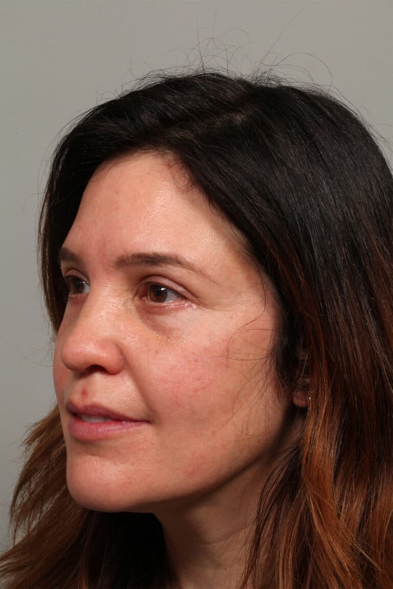 After Image: Upper and Lower Blepharoplasty - front