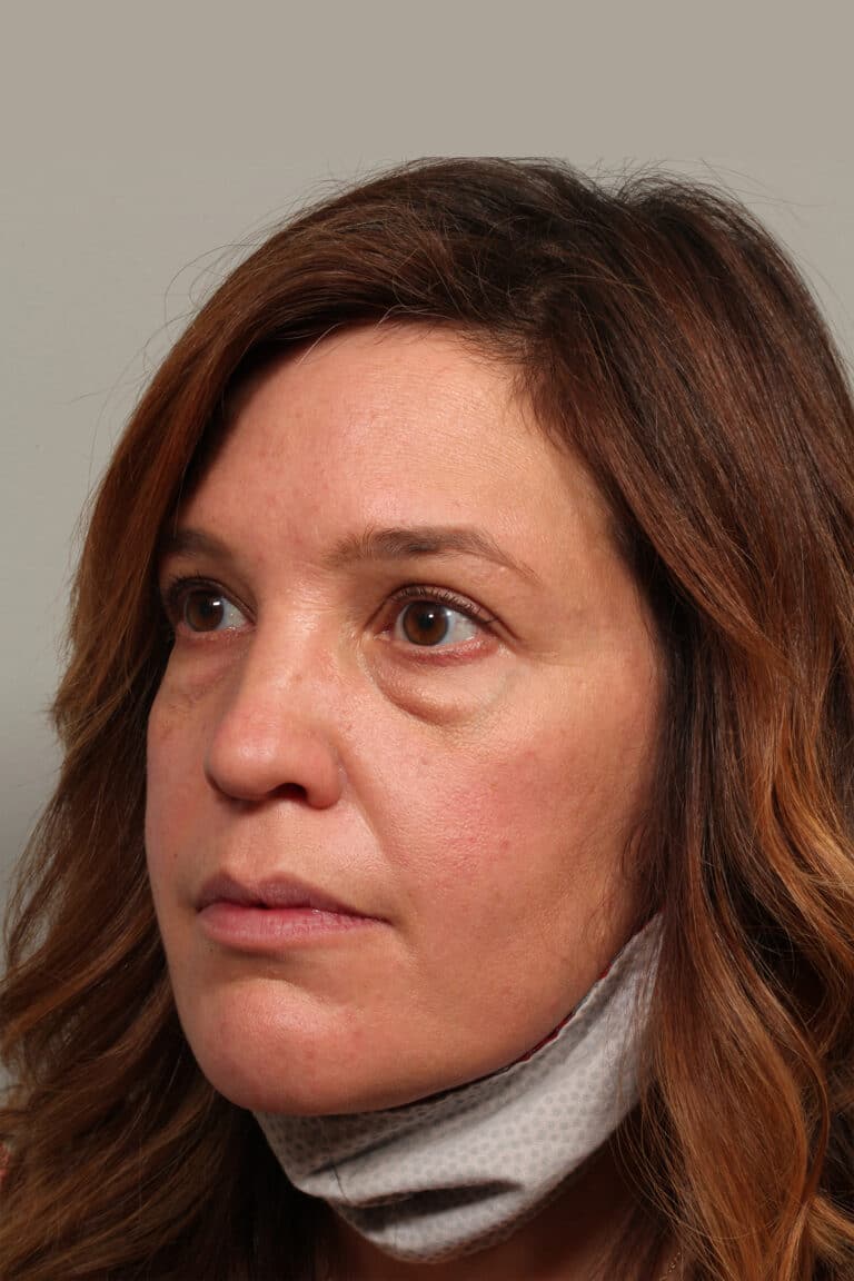 Before Image: Upper and Lower Blepharoplasty - front