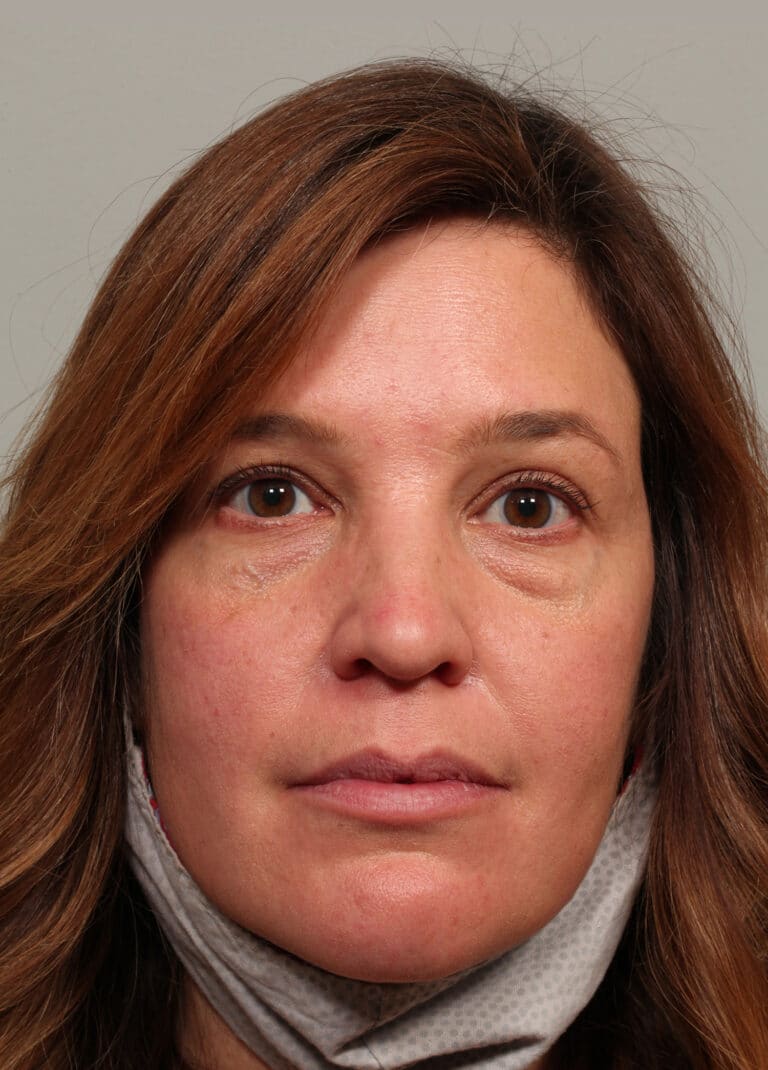 Before Image: Upper and Lower Blepharoplasty - front