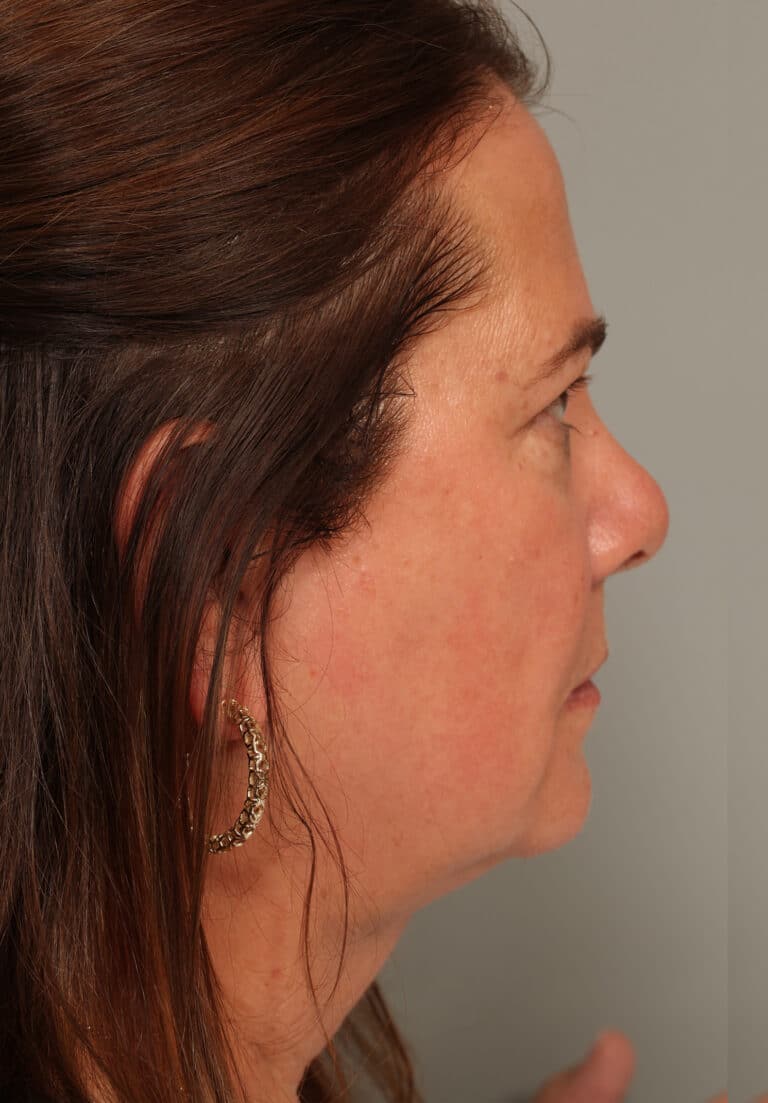 After Image: Neck Liposuction - right-side