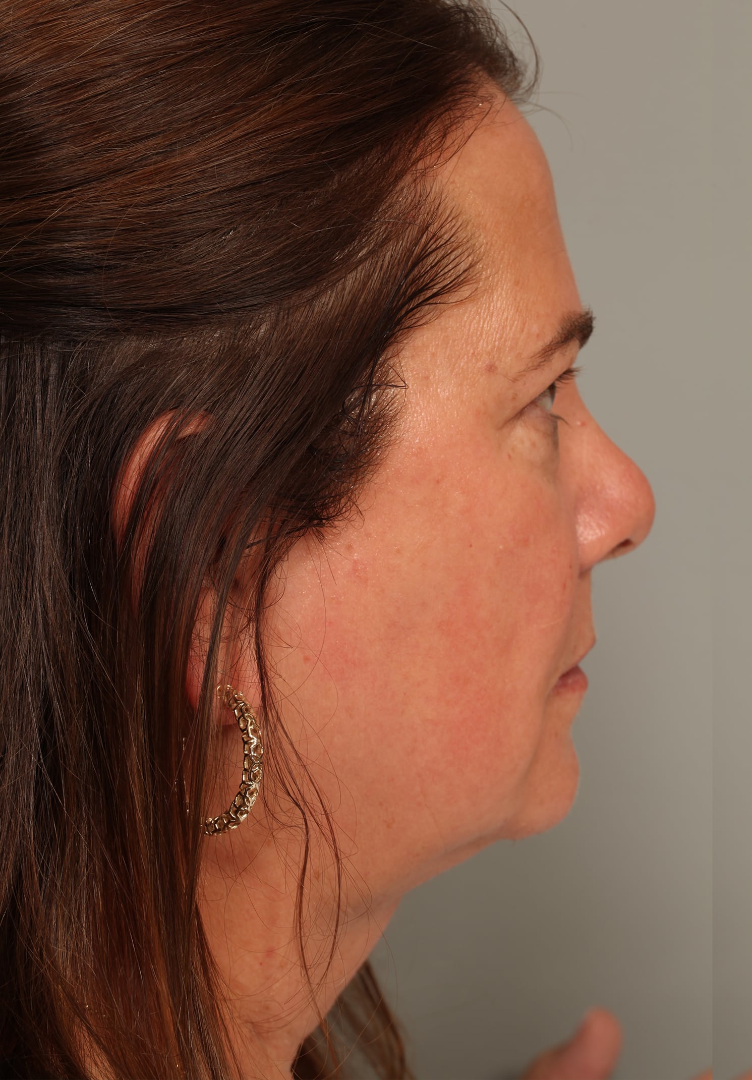 After Image: Neck Liposuction - right-side