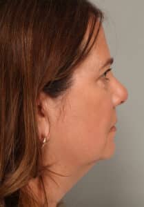 Before Image: Neck Liposuction