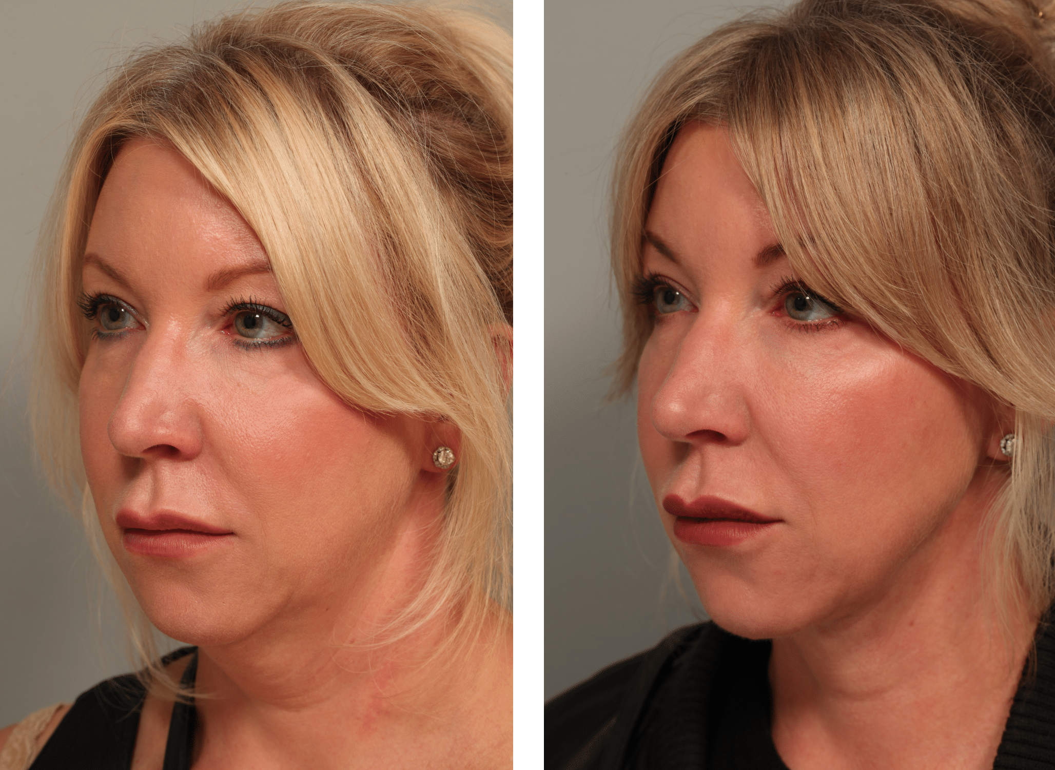 54 Before angle facetite neck lipo Morpheus8 Restylane lower lids.JPG 1