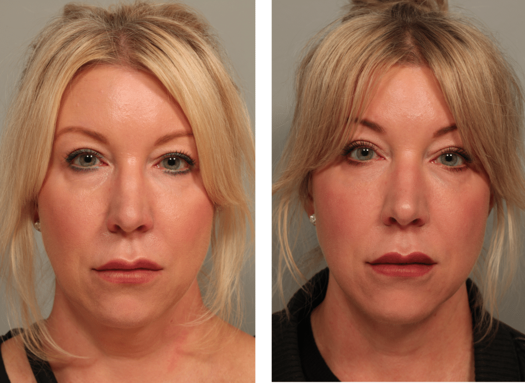 54 Before front facetite neck lipo Morpheus8 Restylane lower lids.JPG 1