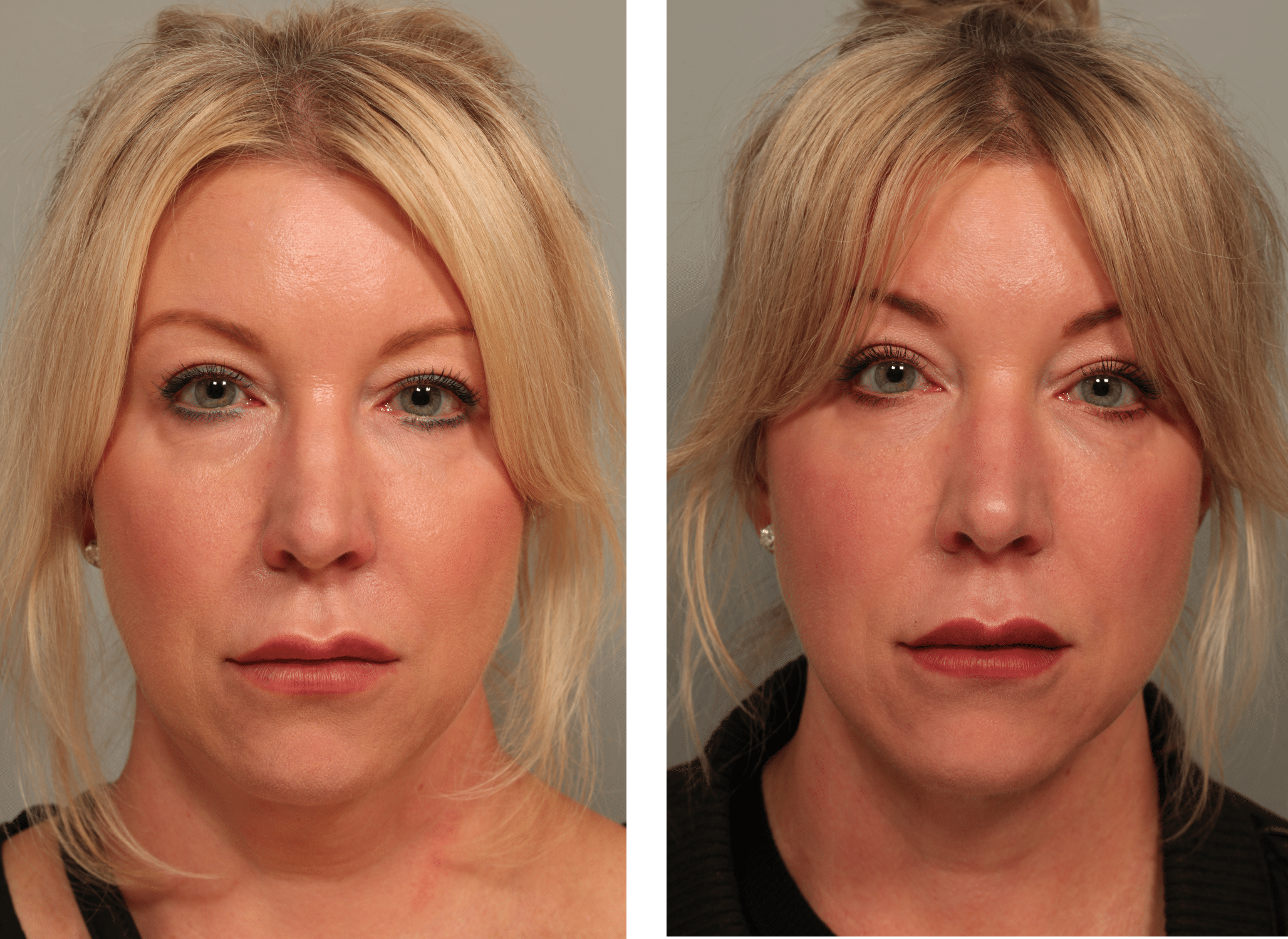 54 Before front facetite neck lipo Morpheus8 Restylane lower lids.JPG 1