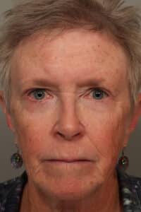 After Image: Blepharoplasty, Eyelids, Browlift