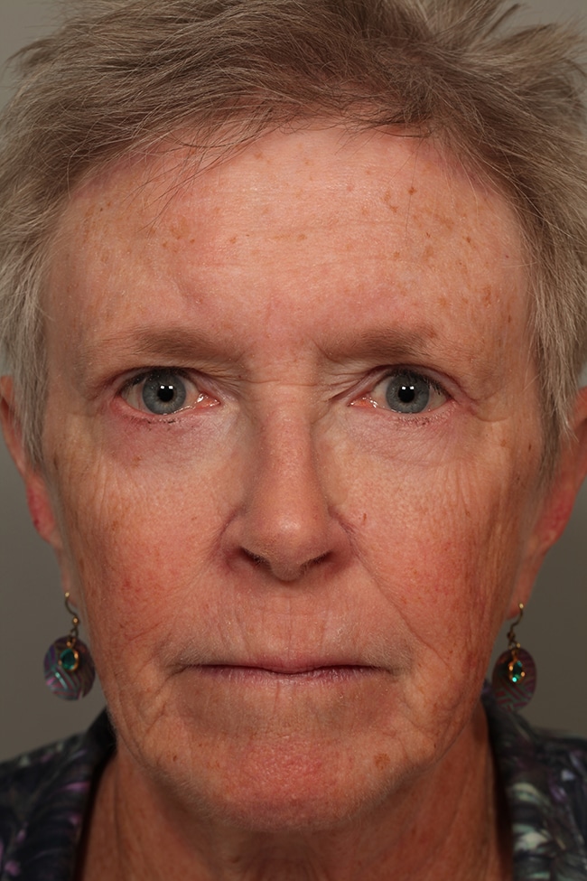After Image: Blepharoplasty, Eyelids, Browlift - front