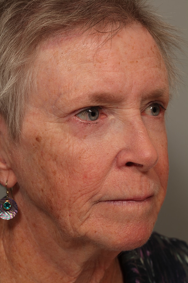 After Image: Blepharoplasty, Eyelids, Browlift - right-front-oblique