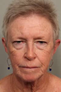 Before Image: Blepharoplasty, Eyelids, Browlift